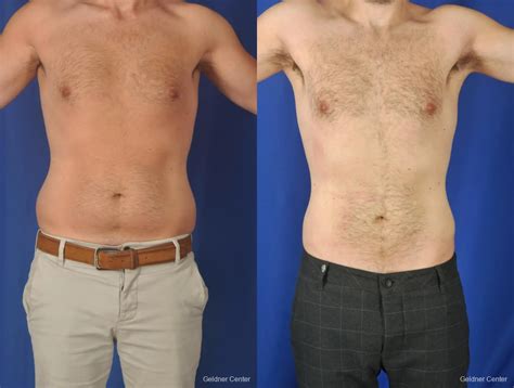 male liposuction miami|Best Liposuction Miami FL